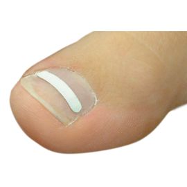 Onyclip Nagelbeugel strips (8 stk), 0,10 mm